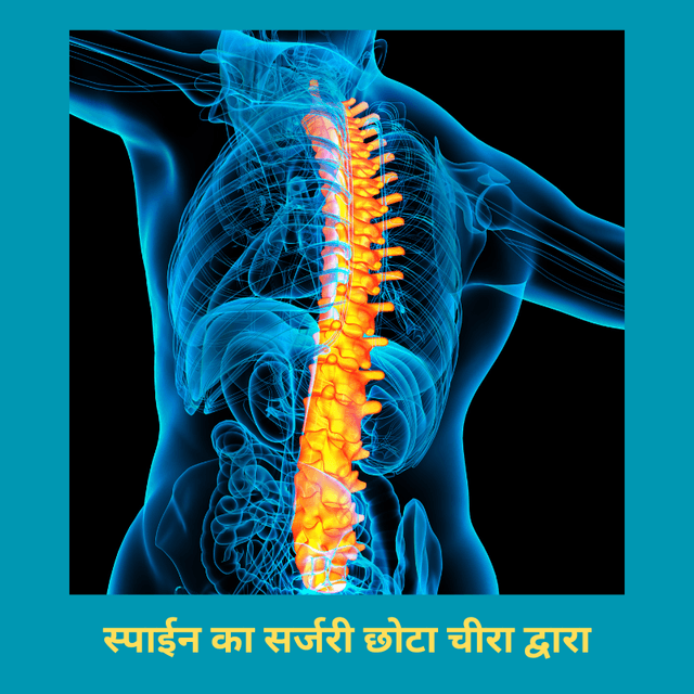 स्पाईन का सर्जरी छोटा चीरा द्वारा