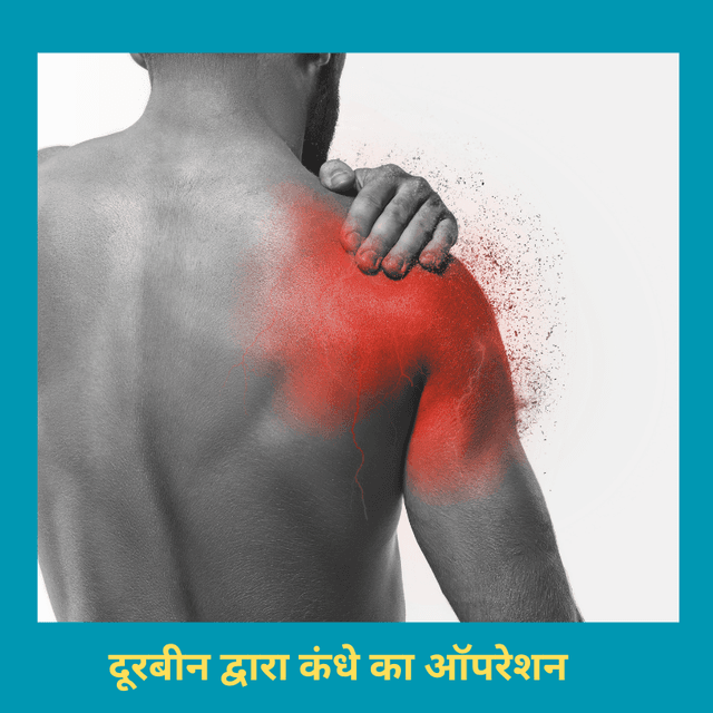 दूरबीन द्वारा कंधे का ऑपरेशन